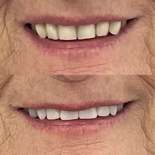 Before and after dentures — Case 1