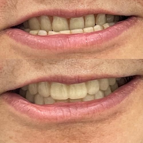 Before and after dentures — Case 3