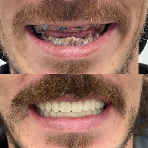 Before and after dentures — Case 4